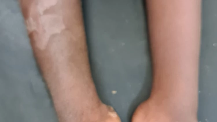 Girl ohne Gips postop